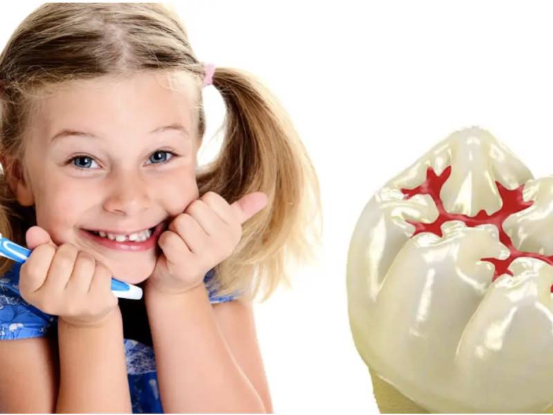 فیشور سیلانت محافظ دندان کودکان