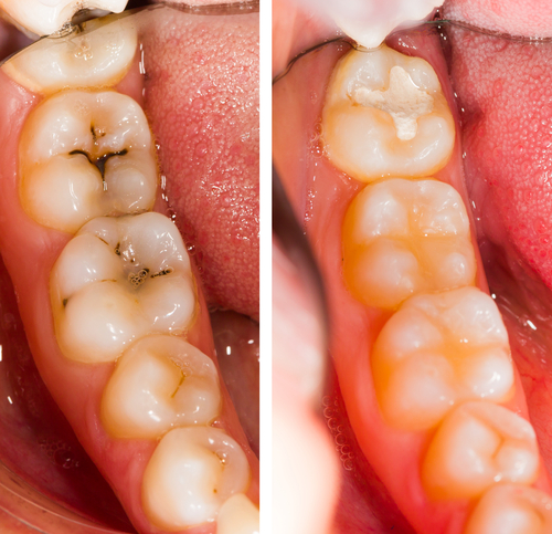  سیلانت مانع پوسیدگی دندان 