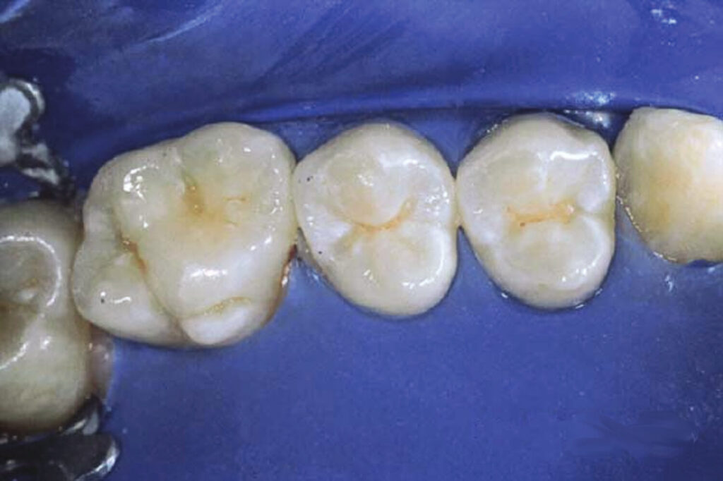  زمان انجام فیشورسیلانت دندان