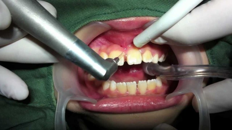 لیزر دندان