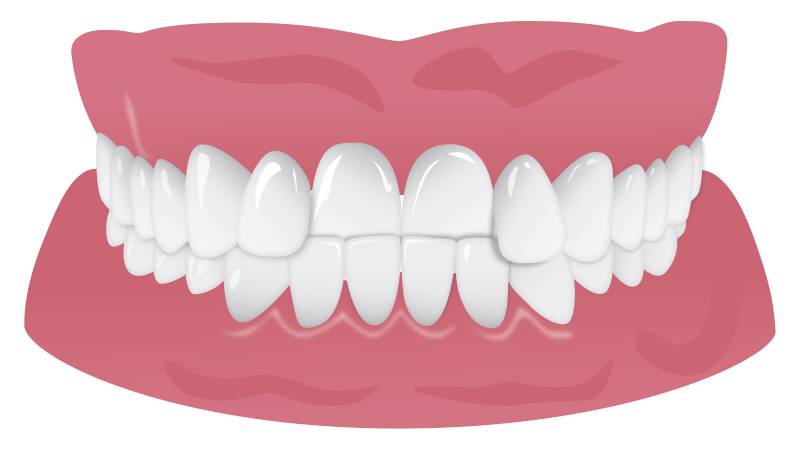 نامرتبی دندان - کراس بایت 
