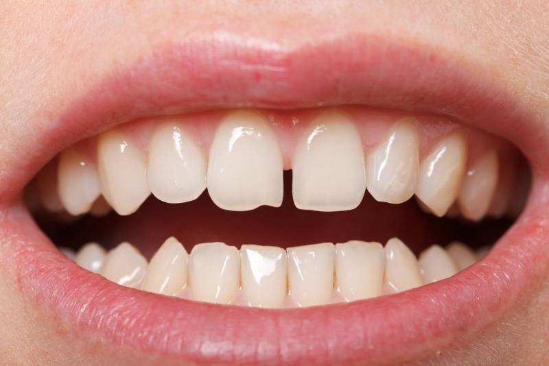  نامرتبی دندان -  فاصله دندان‌ها