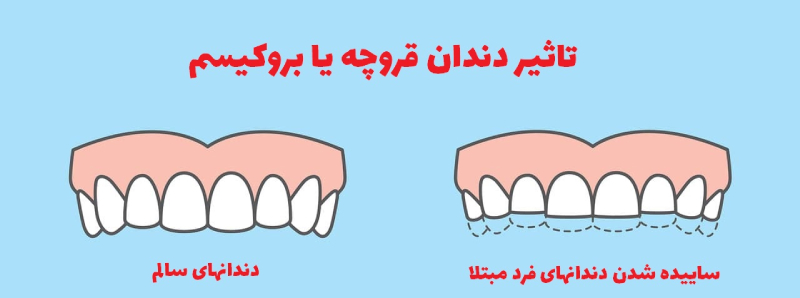 دندان قروچه و سایش دندان