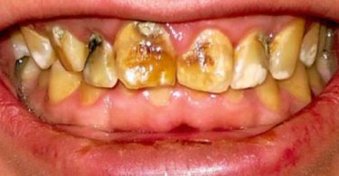 فلوئوروزیس دندان
