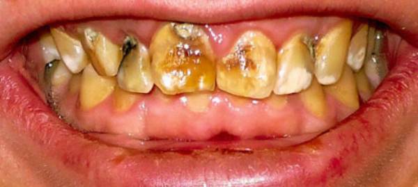 فلوئوروزیس دندان