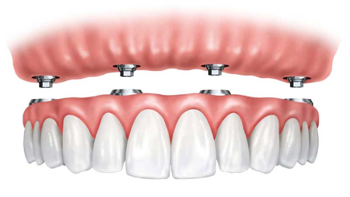 دندان مصنوعی ثابت بر پایه ایمپلنت