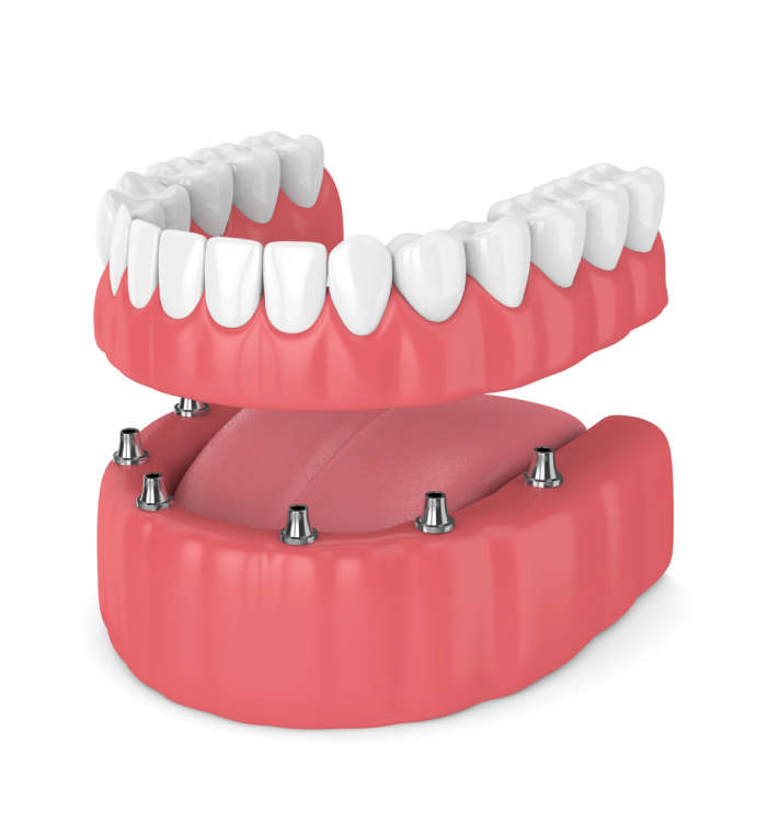دندان مصنوعی ثابت چیست؟