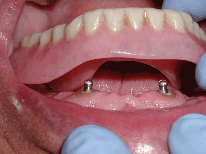 ساخت دندان های مصنوعی ثابت بر پایه ایمپلنت