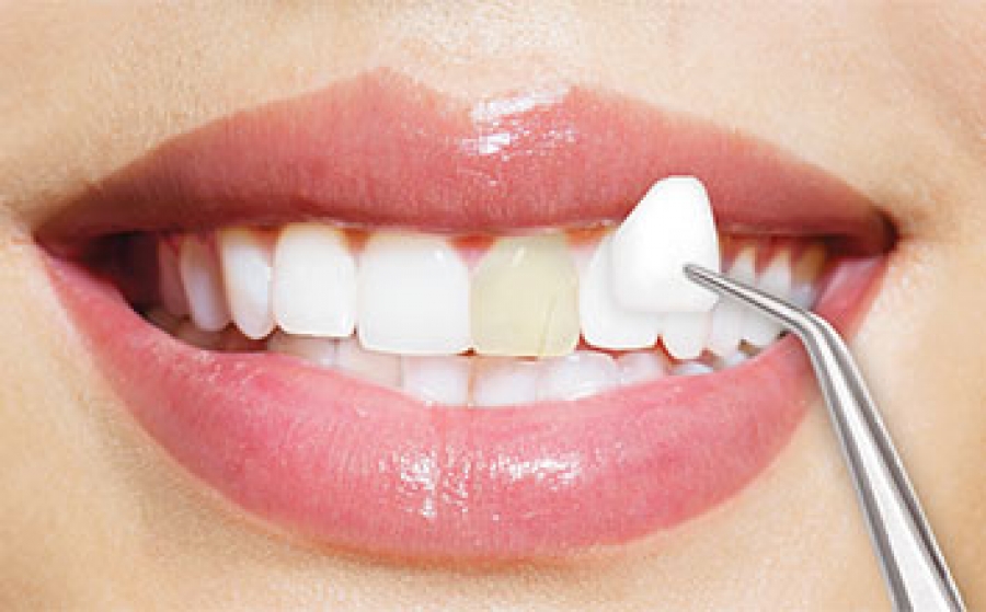 کامپوزیت دندان چیست و چگونه انجام می شود؟