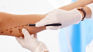 براکیوپلاستی