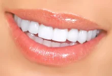 لمینت کریستالی دندان