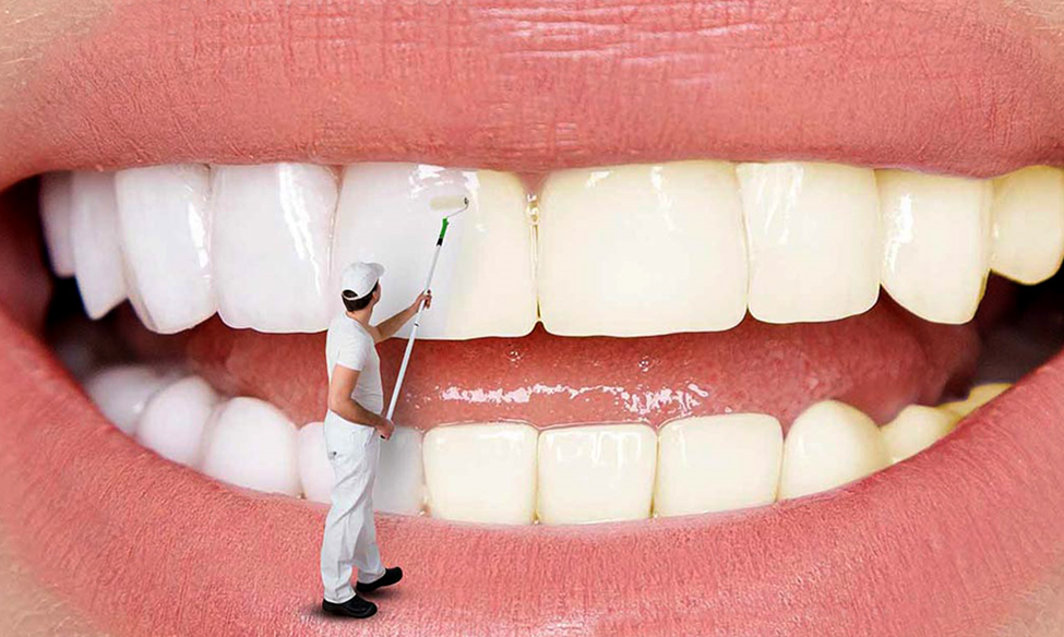 پلیچینگ دندان