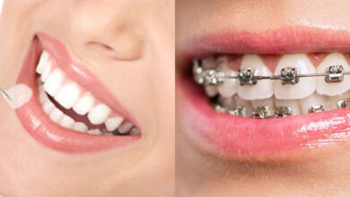 کامپوزیت بهتر است یا ارتودنسی