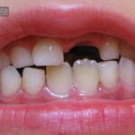 علل طبیعی و بی خطر تأخیر در رویش دندان های دائمی