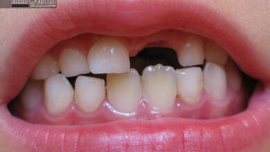 علل طبیعی و بی خطر تأخیر در رویش دندان های دائمی