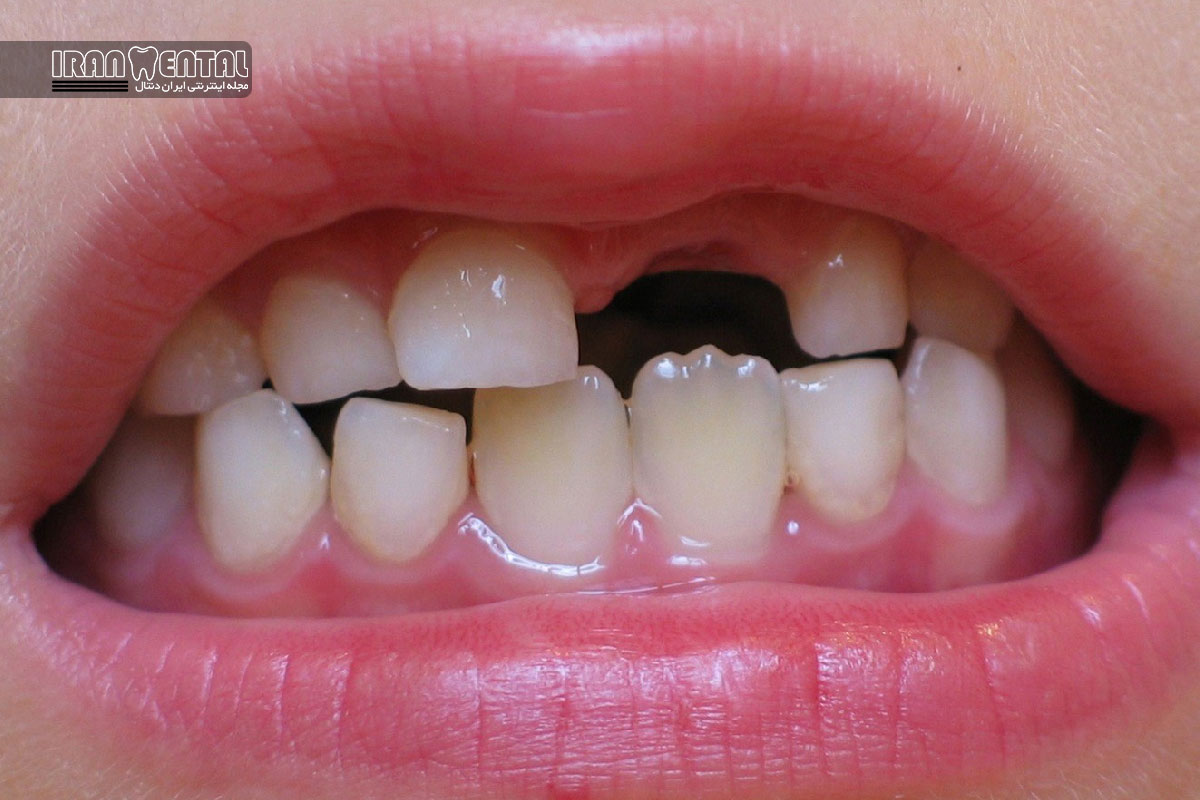 علل طبیعی و بی خطر تأخیر در رویش دندان های دائمی