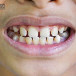 افزایش فاصله بین دندان های شیری کودک