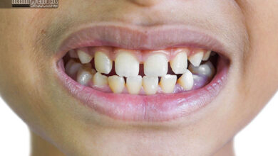 افزایش فاصله بین دندان های شیری کودک