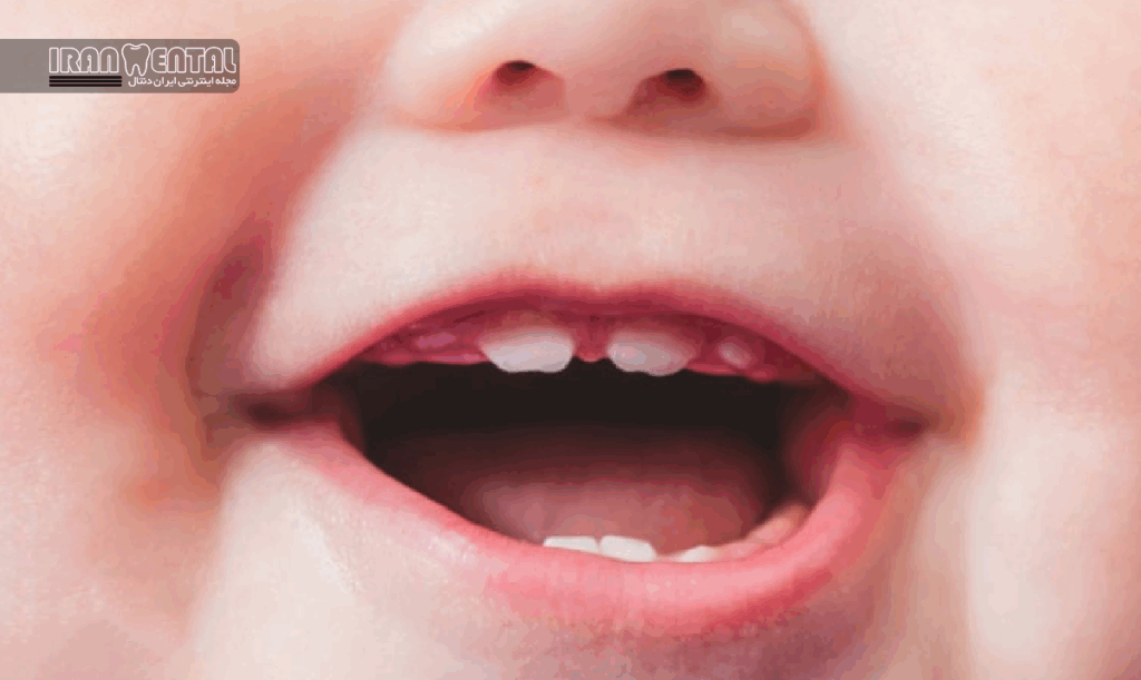 نقش ژنتیک و وراثت در فاصله بین دندان های شیری