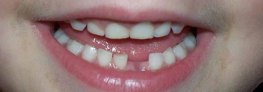 علل طبیعی و بی خطر تأخیر در رویش دندان های دائمی