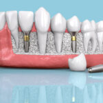 ایمپلنت دندان در اصفهان با شرایط اقساطی