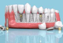 ایمپلنت دندان در اصفهان با شرایط اقساطی