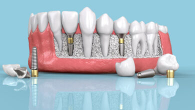 ایمپلنت دندان در اصفهان با شرایط اقساطی