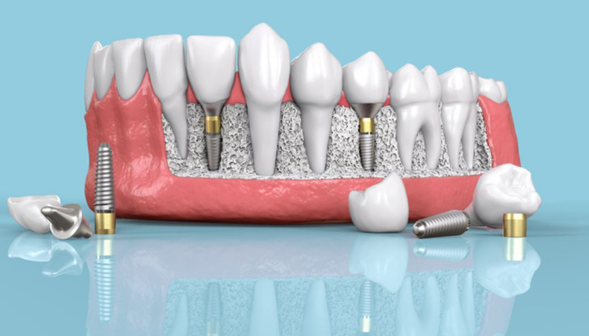 ایمپلنت دندان در اصفهان با شرایط اقساطی