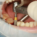 ۵ اشتباه رایج بیماران بعد از جراحی ایمپلنت که باعث شکست درمان می شود-ایران دنتال