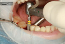 ۵ اشتباه رایج بیماران بعد از جراحی ایمپلنت که باعث شکست درمان می شود-ایران دنتال