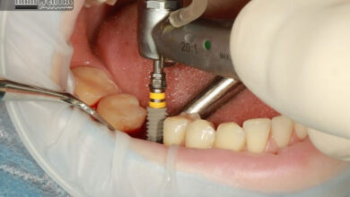 ۵ اشتباه رایج بیماران بعد از جراحی ایمپلنت که باعث شکست درمان می شود-ایران دنتال