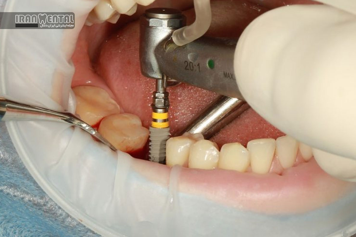 ۵ اشتباه رایج بیماران بعد از جراحی ایمپلنت که باعث شکست درمان می شود-ایران دنتال