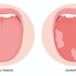  لکوپلاکیا؛ علائم، روش تشخیص، درمان و علت ایجاد