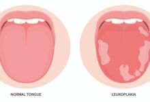  لکوپلاکیا؛ علائم، روش تشخیص، درمان و علت ایجاد