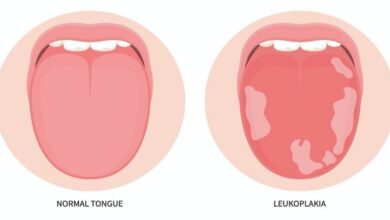  لکوپلاکیا؛ علائم، روش تشخیص، درمان و علت ایجاد