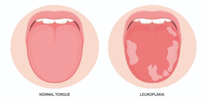  لکوپلاکیا؛ علائم، روش تشخیص، درمان و علت ایجاد