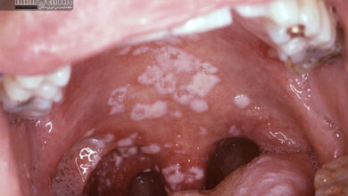 ضایعات سفید در دهان؛ از لکوپلاکی تا علائم خطرناک تر