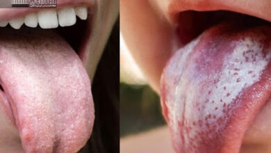 سفیدک دهان یا لکوپلاکی چیست و چه تفاوتی با برفک دهان دارد؟