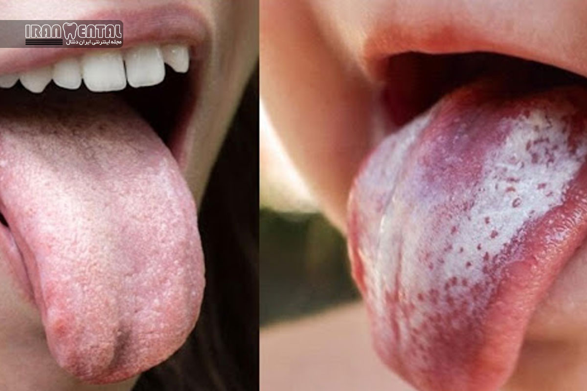 سفیدک دهان یا لکوپلاکی چیست و چه تفاوتی با برفک دهان دارد؟