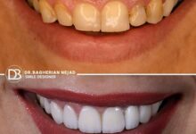 کامپوزیت لبه شیشه ای اصفهان