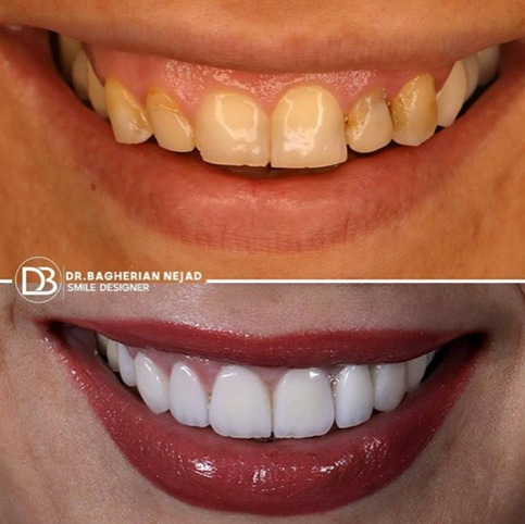 کامپوزیت لبه شیشه ای اصفهان