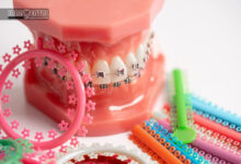 ارتودنسی سریع چیست و برای چه کسانی مناسب است؟