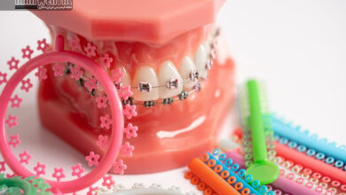 ارتودنسی سریع چیست و برای چه کسانی مناسب است؟