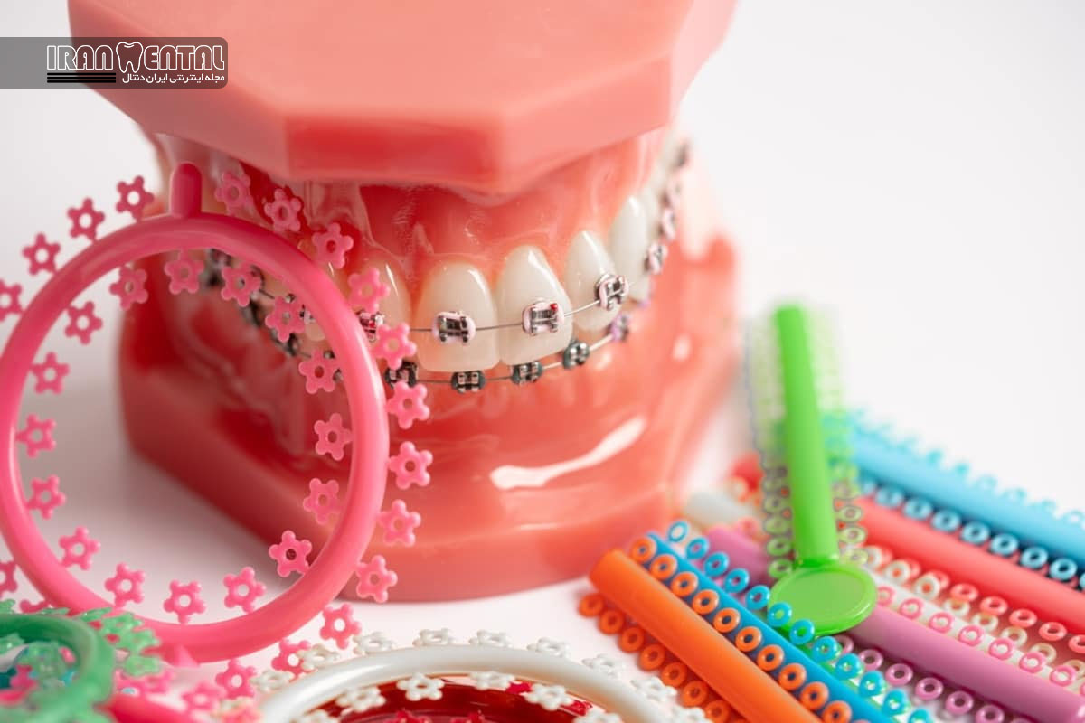 ارتودنسی سریع چیست و برای چه کسانی مناسب است؟