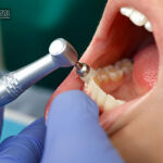 جرم گیری دندان در خانه؛ واقعیت یا شایعه و چه روش هایی واقعا بی خطر و موثرند؟