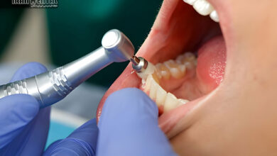 جرم گیری دندان در خانه؛ واقعیت یا شایعه و چه روش هایی واقعا بی خطر و موثرند؟