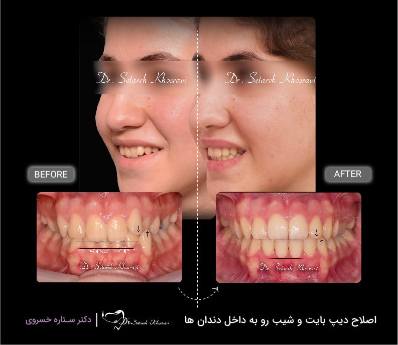 اصلاح دیپ بایت