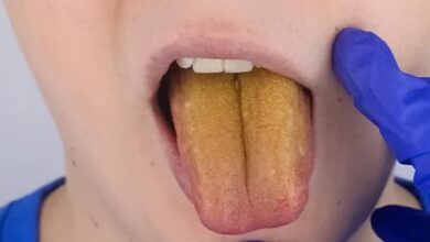 درمان زرد شدن زبان