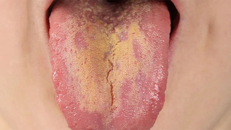 زردی زبان به دلیل عدم رعایت بهداشت دهان