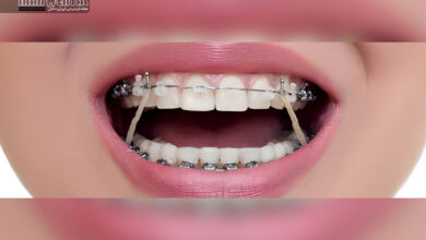 باندینگ دندان چیست و چقدر ماندگاری دارد؟ بررسی مزایا معایب هزینه و دوام واقعی باندینگ دندان